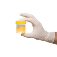 Protéinurie: protéines dans les urines